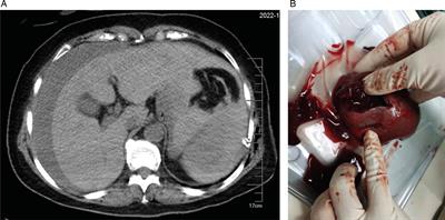Case Report: Hemodynamic Instability Caused by Splenic Rupture During Video-Assisted Thoracoscopic Lobectomy
